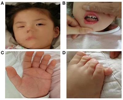 Case Report: Identification of a de novo Microdeletion 1q44 in a Patient With Seizures and Developmental Delay